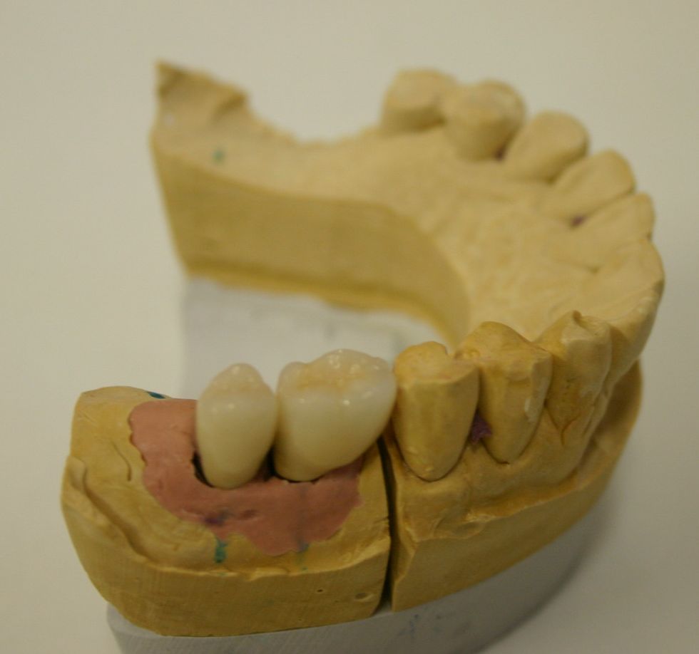 Dental implant educational model for first-time patients.