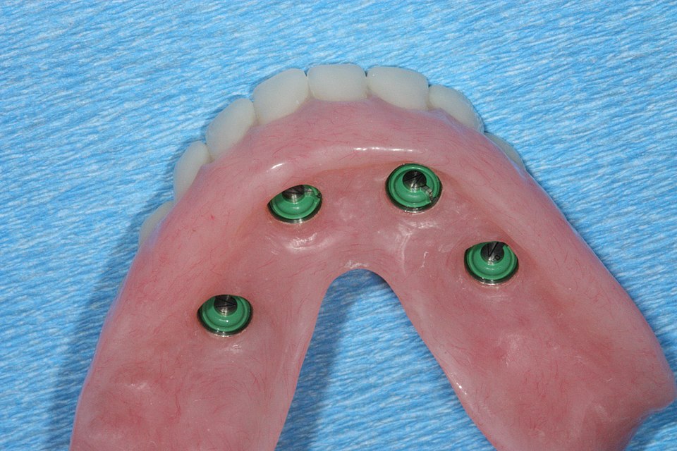 Implant-supported restorative model showing a fixed foundation.