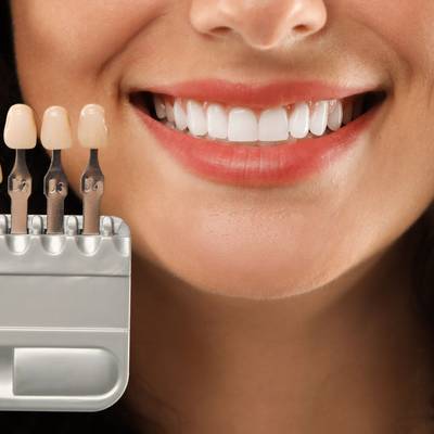 Veneer mock-up on a dental model